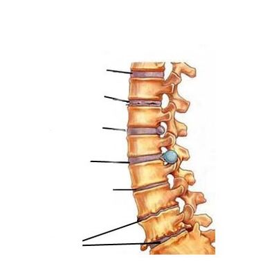 Az osteochondrosis fejlődésének szakaszai