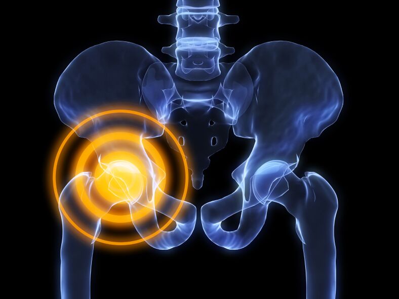 a csípőízület arthrosisa